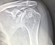 This is an X-ray of Rolla Goodyear'’s left shoulder before surgery